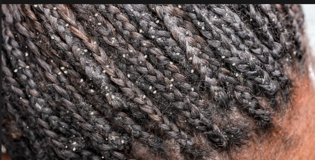 Probiotics And How They Can Prevent Dandruff